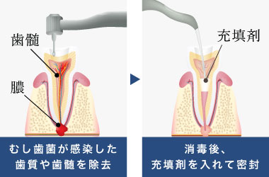 むし歯菌が感染した歯質や歯髄を除去し、消毒後、充填剤を入れて密封