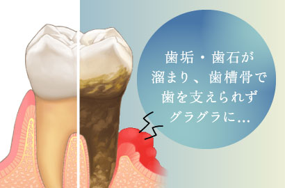 歯垢・歯石が溜まり、歯槽骨で歯を支えられずグラグラに…